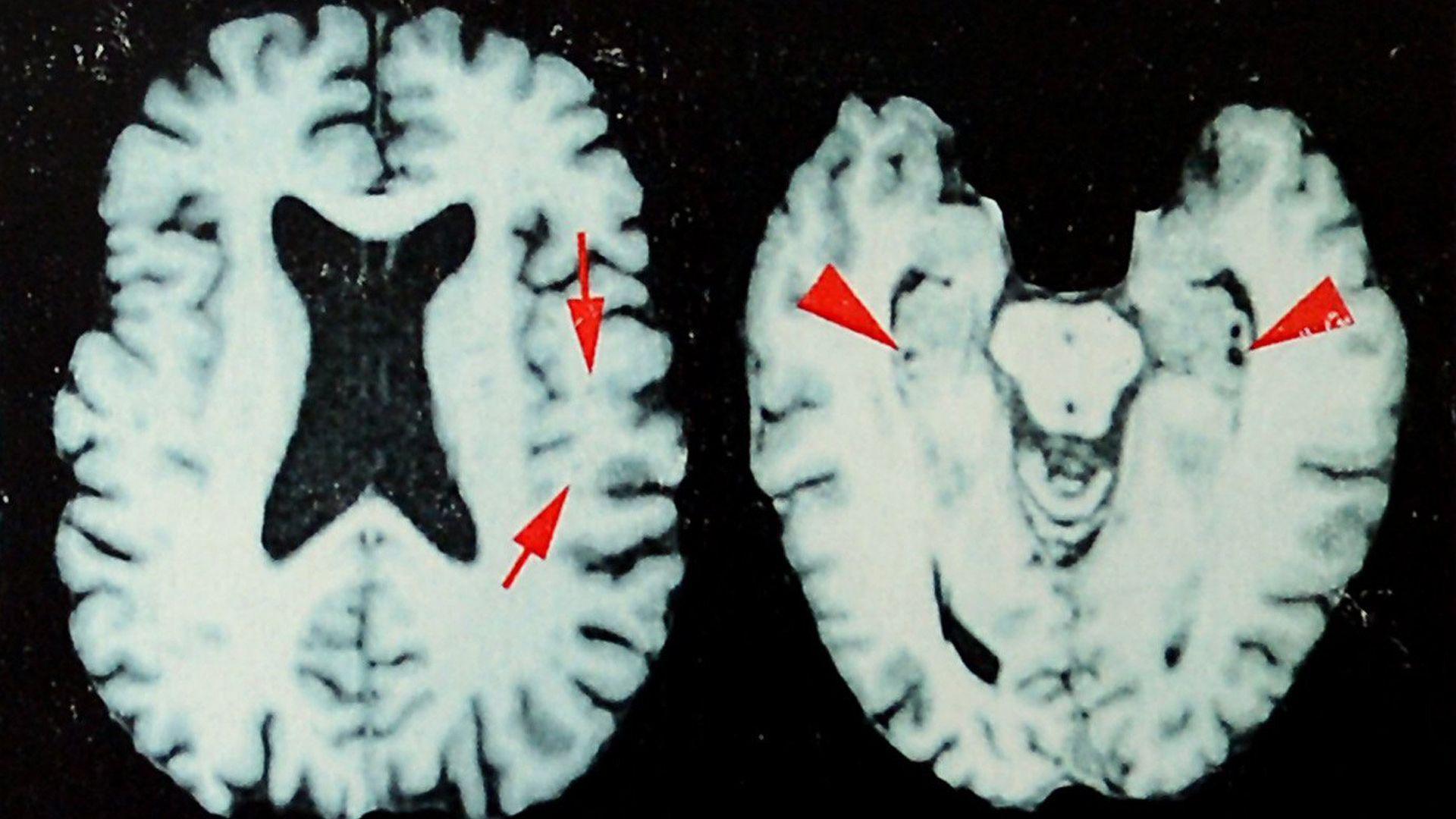 Exames cerebrais de um ex-jogador da NFL diagnosticado com encefalopatia traumática crônica